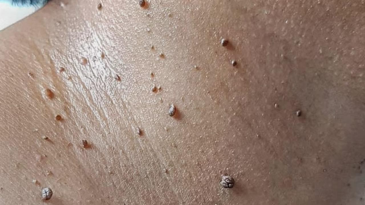 Skin-Tag Removal